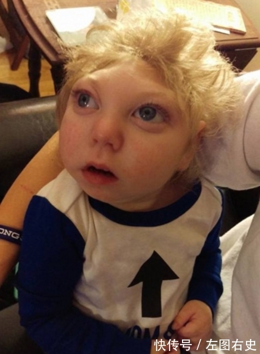 畸形儿|小男孩出生只有“半个脑袋”,好像被削去了,医生:活不过3个月