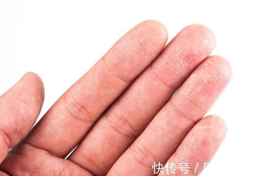 多汗|发现手部动不动就出汗,要警惕或是2种因素引起的,要及时检查