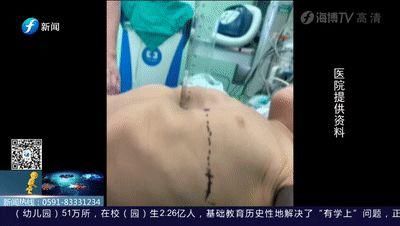  女童|5岁女童＂漏斗胸＂凹陷紧邻心脏，离脊椎不足5厘米！