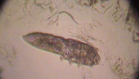 蓉蓉|三种现象证明你脸上长了螨虫,还在用醋洗脸吗,难怪没效果