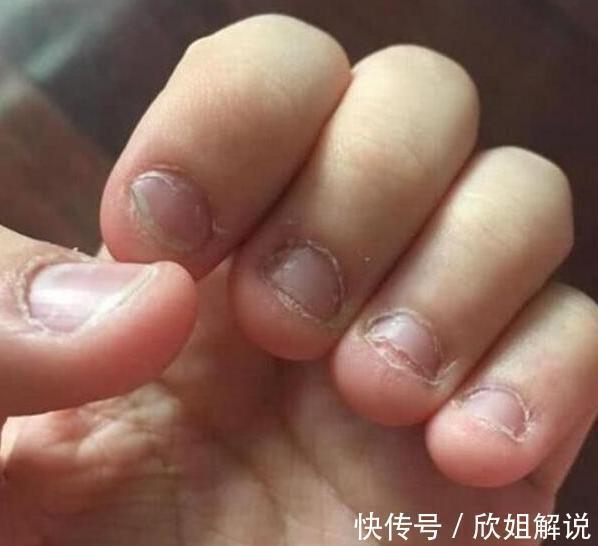 指甲|从小“咬指甲”的孩子,长大后会变成什么样逃不掉这两种结局
