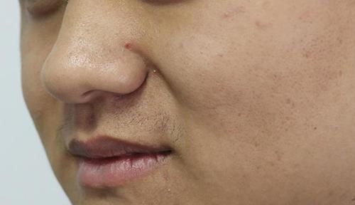 湿气也分种类内湿和外湿，湿寒和湿热，老中医帮你分的清清楚楚