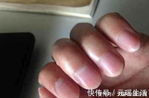 红甜菜|肝癌“来势汹汹”？手指出现一“异常”，肝脏已在悄悄“癌变”