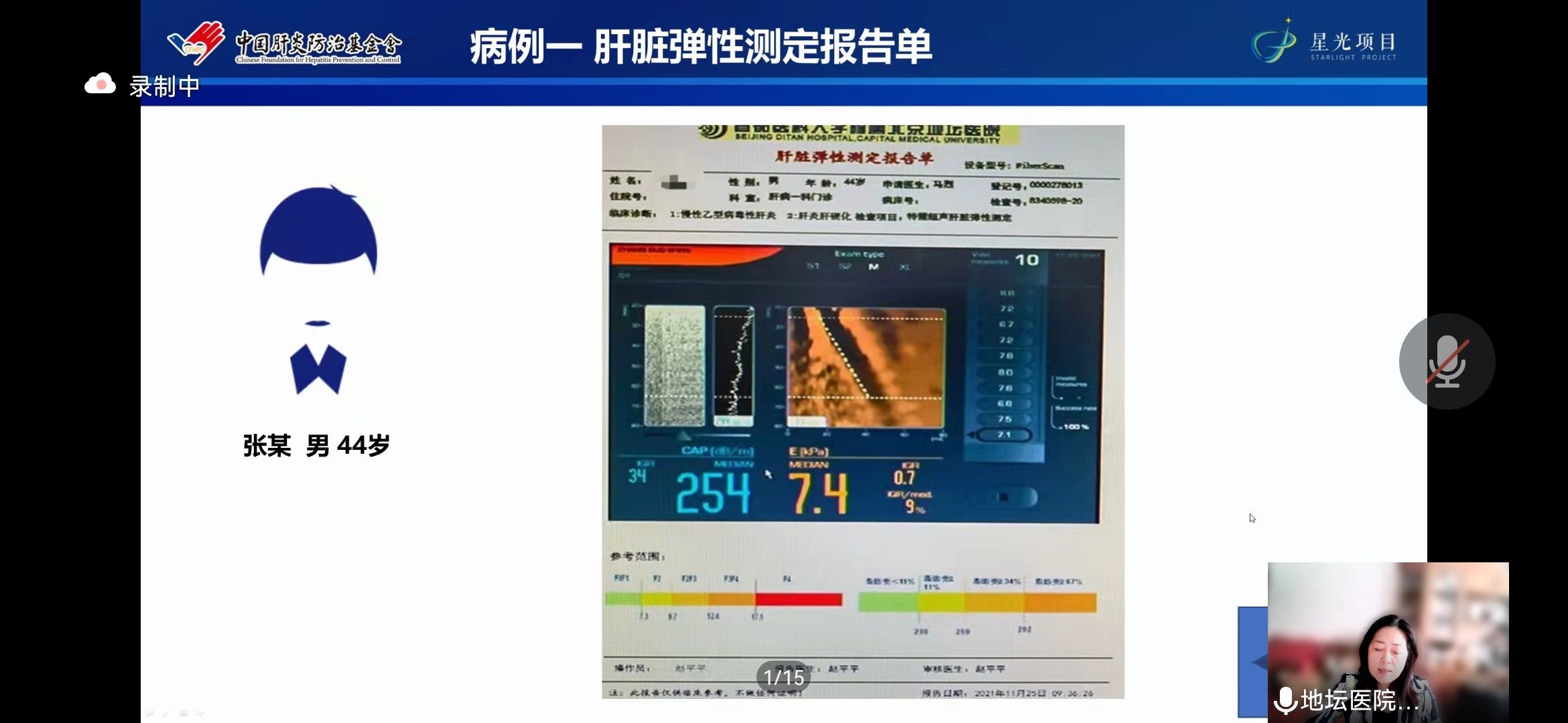 中国肝炎防治基金会|马烈教授《早癌筛查阴性病例分享》