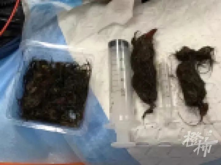 女孩|11岁女孩胃内发现毛发结石，专家灵机一动，女孩成功躲过破胃手术