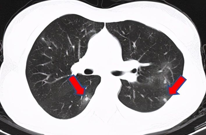 结节|刀下“留肺”!容易误认为癌性“肺结节”的8种感染