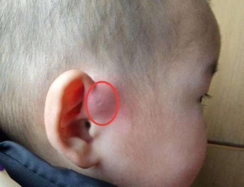 富贵洞|你家宝宝耳朵上有“富贵洞”吗?如果有,家长们可要多留心了