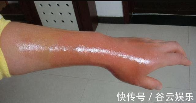 纱布|4岁儿子被开水烫伤,妈妈的“两个果断”救了娃,医生称赞做得对