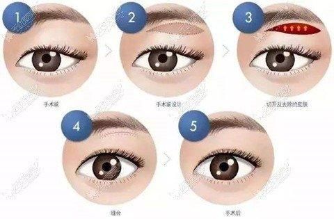 提眉可以改善上睑下垂的问题吗？