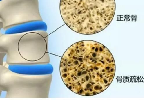 骨骼|黑豆易引发骨质疏松？医生提醒：2绿1白“偷钙”食物，尽量少吃