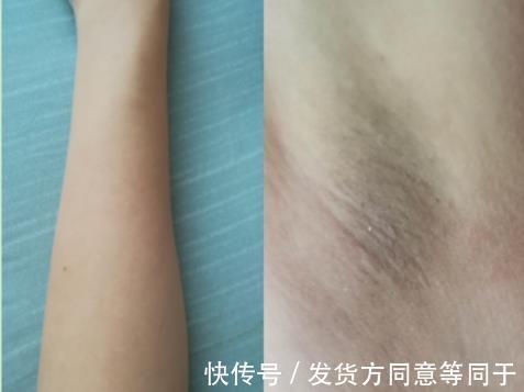 拆君|评测 ｜ 历时30天，真人实测娜蜜丝冰钻6.5高能量光子脱毛仪