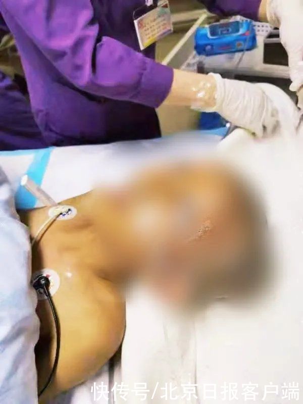 东莞市儿童医院|命悬一线!被妈妈用农药焗头驱虱,11岁女孩进了ICU