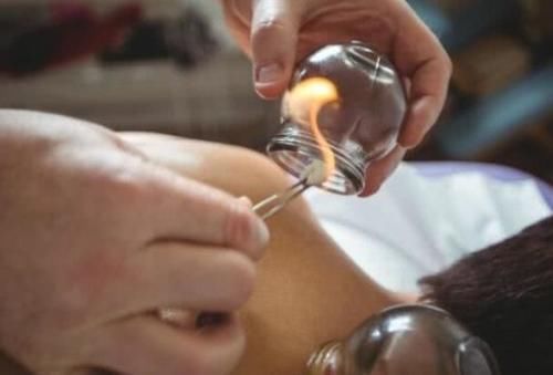 黑印|拔罐的黑印真的是体内毒素吗拔罐师傅给出解释,看完长见识了