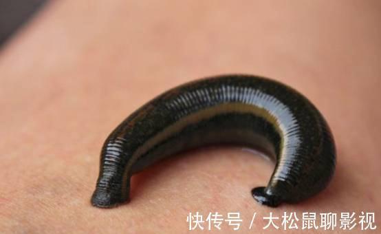 男孩|蚂蟥能在人体内长期存活吗?5岁男孩不小心吞进肚,1年后才发现