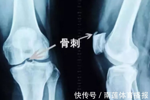 骨质增生|很多“病”并不算病,只是人老了,以下4类疾病,无需过度治疗