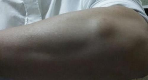 脂肪瘤|治“脂肪瘤”的小方子来了偷学来的险招，治疙瘩不痛、不痒