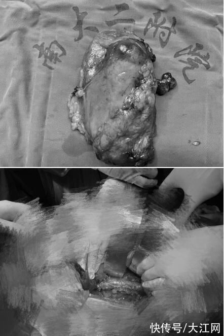 刘飞|南昌大学二附院泌尿外科成功完成一例肾癌根治+下腔静脉II级癌栓取出术