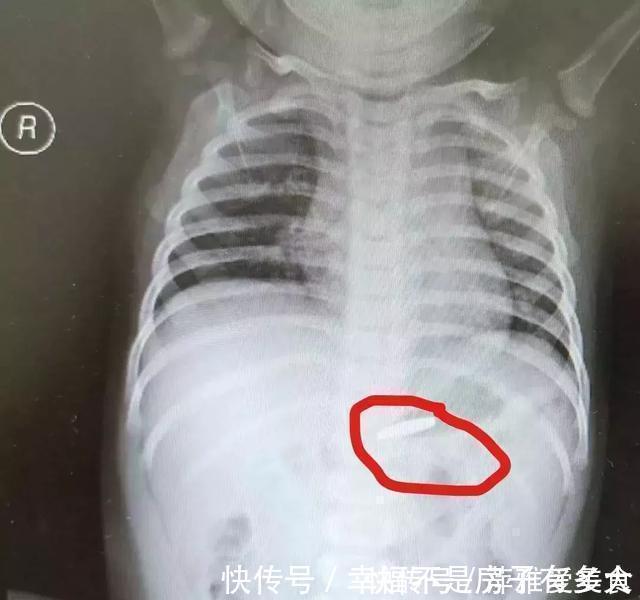 毒物|小小一枚,孩子喉管被腐蚀!再说一遍,这些东西必须放好了