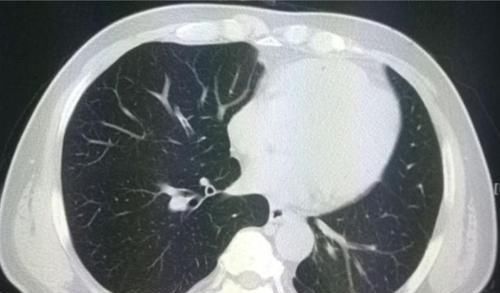 肺结节|癌症病人的幸运指数不一样，这位老太太想感谢一个吹破的肺大泡