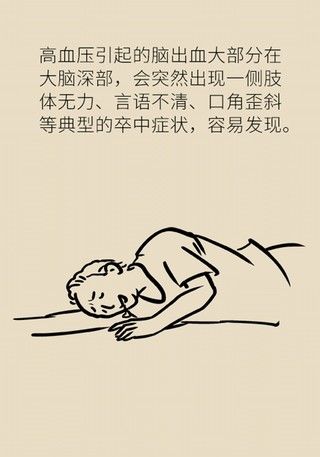 瞌睡|记性变差容易瞌睡，有可能是这种脑出血
