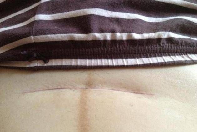 麻药|头胎剖腹产,第二胎继续剖,到底有多痛这些有经验的宝妈这样说