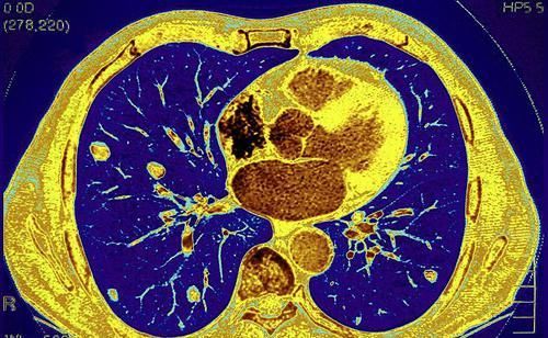 肺癌会引起咳嗽？主要有这4个特征，早期发现或能保命