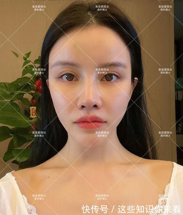 下垂 32岁姑娘小拉皮术后7个半月,变得年轻又精致,前后反差很大!