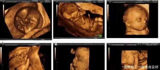 彩色|普通B超、彩超和三维、四维彩超有什么区别,孕妈带你图解!