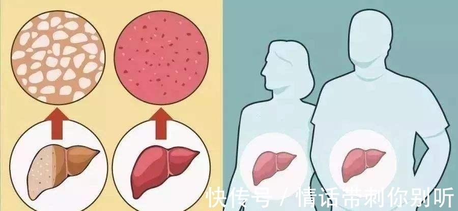 优质蛋白|为什么一直吃素还得脂肪肝？专家提醒：脂肪肝最怕的，不是脂肪！