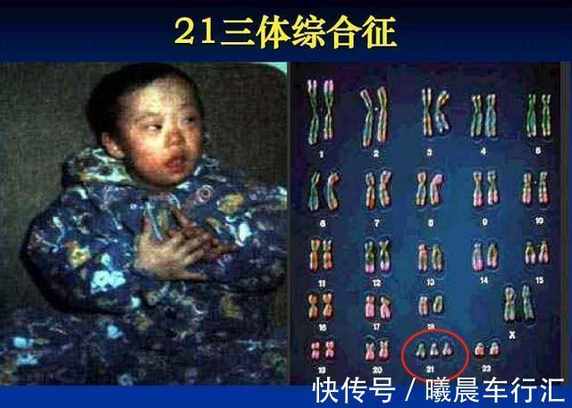 nt|世界唐氏综合征日:三类孕妇易怀“唐氏儿”,两项产检筛查很关键