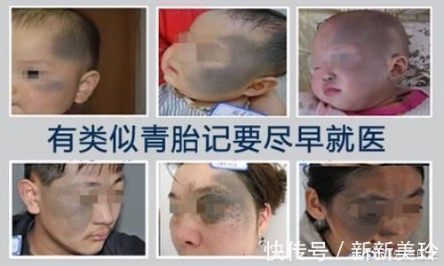 胎记|胎记需要治疗吗?医生告诉你,这些胎记不治疗真的不行!
