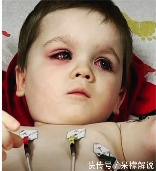 母亲|外国小孩儿洗澡后双眼通红,原来是粗心母亲忘了小心“小黄鸭”