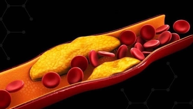 心脑血管|天然的“阿司匹林”食物！每天吃一点，疏通血管，预防血栓