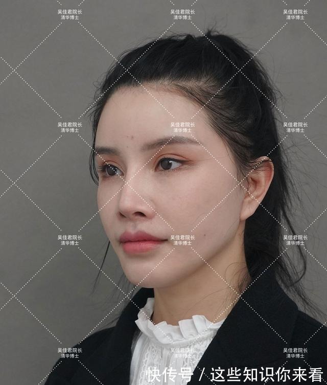 下垂 32岁姑娘小拉皮术后7个半月,变得年轻又精致,前后反差很大!