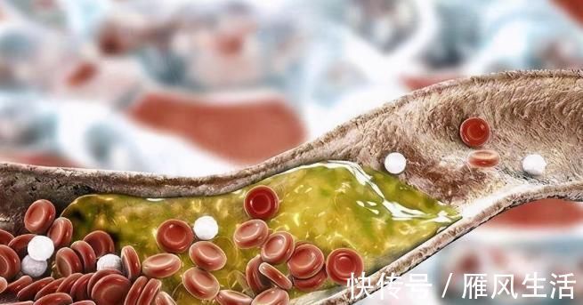 甘油三酯升高|甘油三酯升高,身体有哪些异常表现?如何预防?医生来讲解