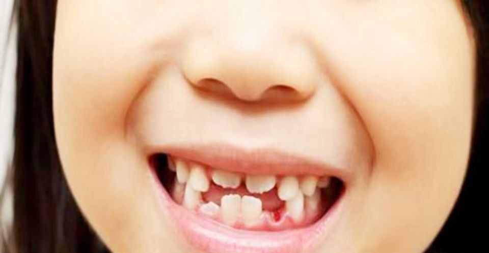 双排牙|7岁的我有一个女孩,奶奶说这是祝福的表示,医生的责备感到羞愧