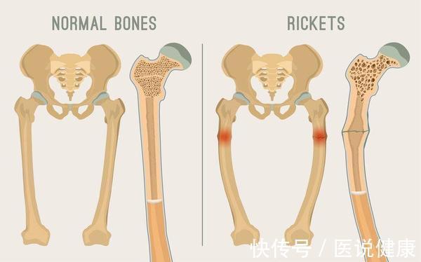 骨密度|老了后,不想被骨质疏松“缠上”,提前做好预防措施,牢记这8点