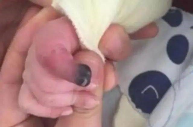 线头|2个月宝宝险被截肢,每小时放一次血!凶手竟是妈妈一根头发