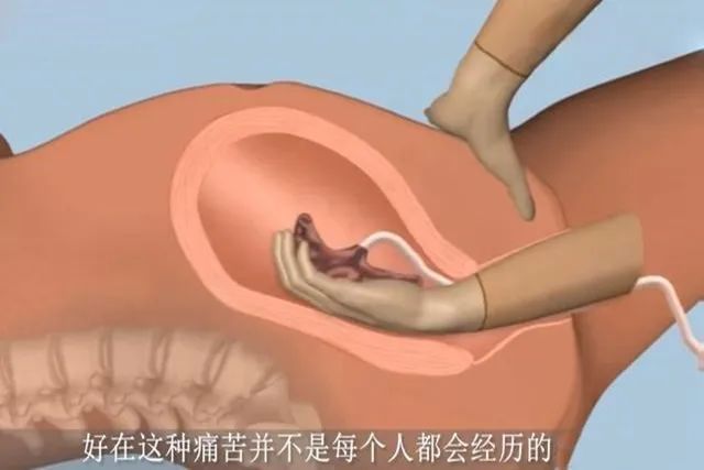 分娩|为什么有些产妇生完孩子后,胎盘不能自动娩出,还需要手剥胎盘