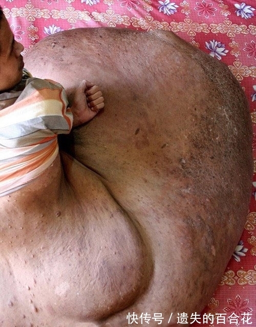 男子|男子的腿长成了一块“大岩石”，天天坐在上面，画面让人害怕