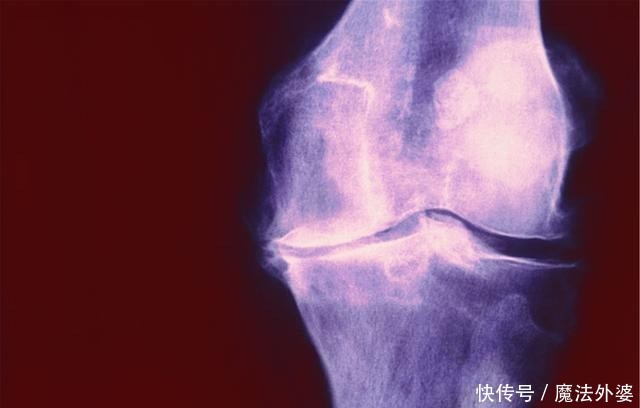 关节|骨质疏松要重视,别等这6个部位疼痛时才想起来,中老年人得当心