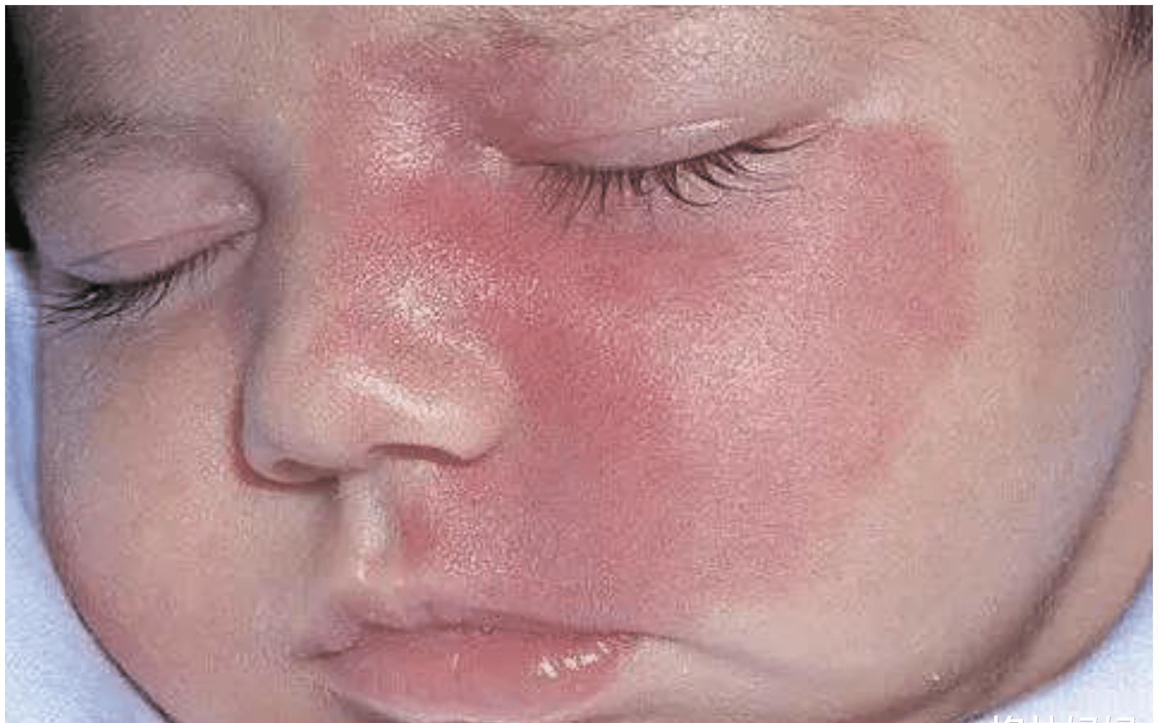 孕妇|胎记是怎么来的？产科医生：孕期这2种行为易长胎记，孕妈要避开