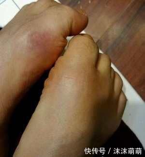 痛风人群|痛风患者大量运动、出汗,就能把尿酸降到正常水平?研究得出结论