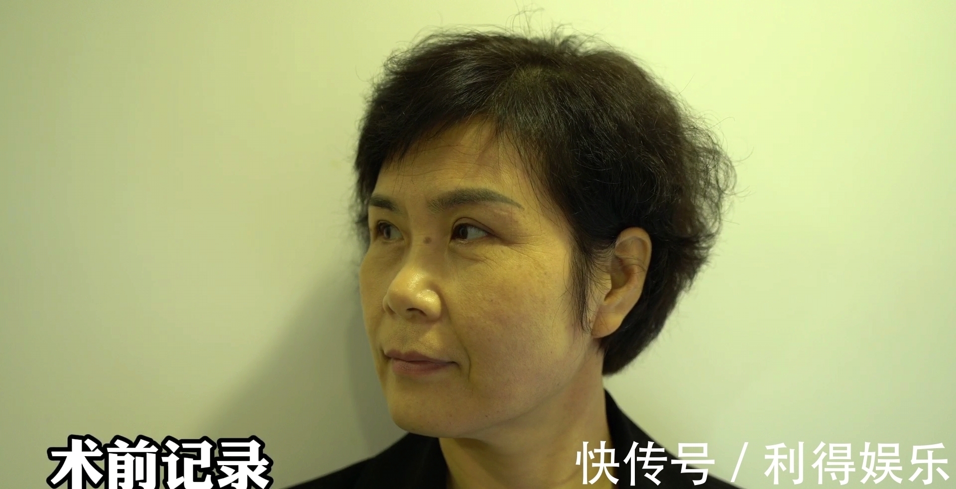 拉皮 48岁女士拉皮手术真实记录,拆线即刻很“惊艳”!