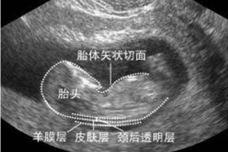 回事|不想生个“傻儿子”，孕期有三项检查不可少，准妈咪别不当回事