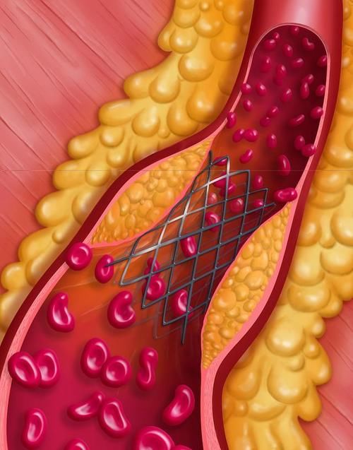 他汀类药物|心血管医生：有个药很多人或在吃，副作用可能比他汀少很多