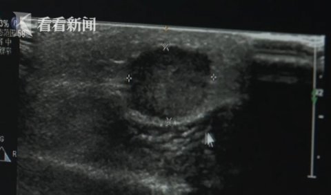 老伯|六旬老伯胸部摸到硬物 一查竟是患上了乳腺癌