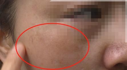 警惕！女子“变美”不成，弄成这样……