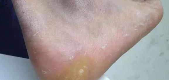修剪|脚上长“茧子”和疾病有关？若脚上出现4种茧子，一定要留意了！