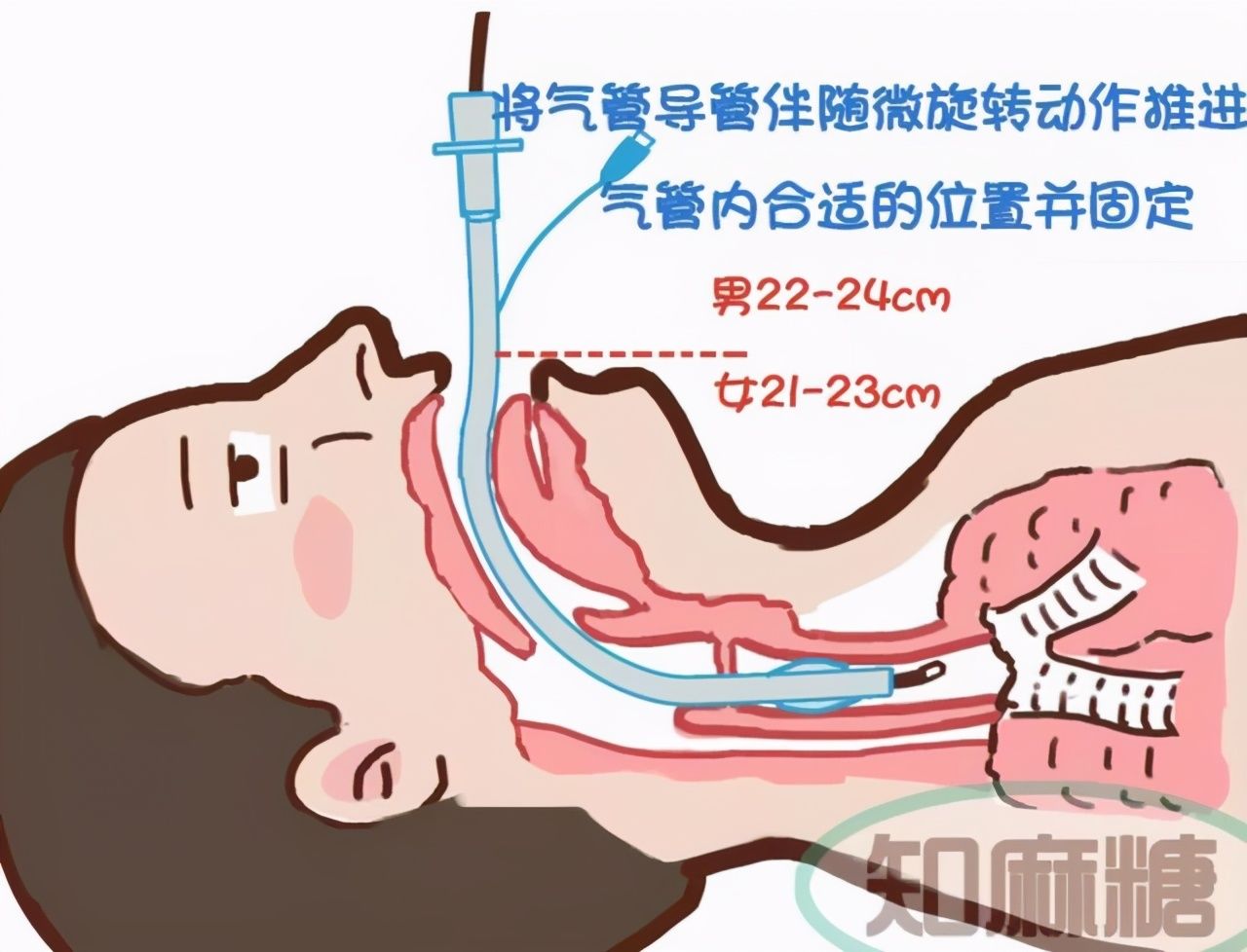 生死时速|你可能不知道，困难气道对麻醉医师的考验有多大